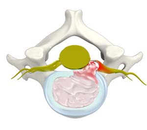 Cervical Herniated Disc