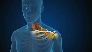 Cervical Radiculopathy Myelopathy