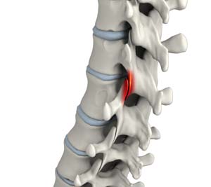 Facet Joint Arthritis